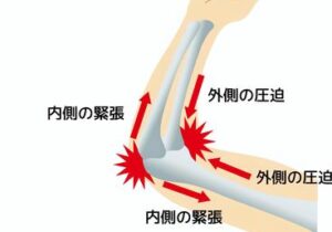 野球肘治療｜船橋｜鍼灸｜たけうち治療院